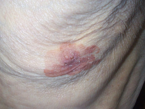 Mammary Paget disease of the skin in a male