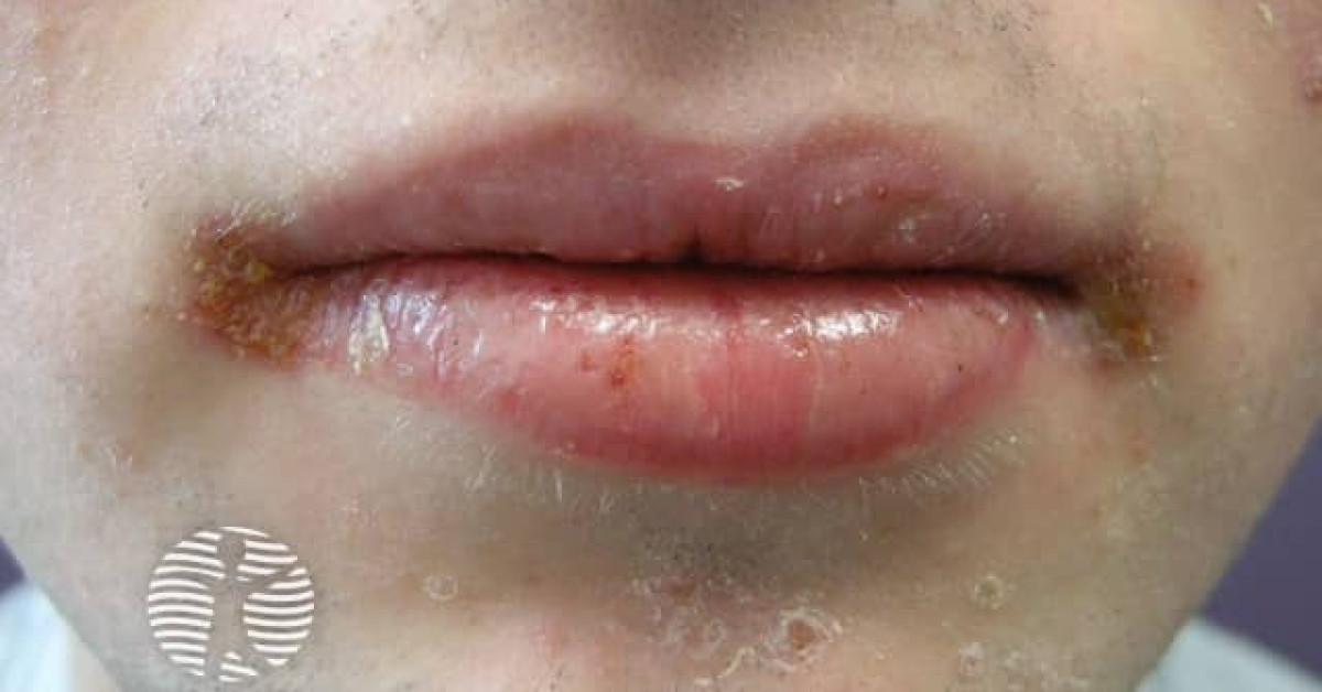 Angular cheilitis image