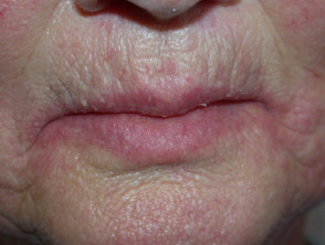 cheilitis: Symptoms, Causes, and Management with — DermNet