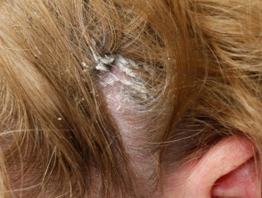 Diagnosis of scalp rashes | DermNet