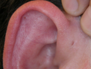 preauricular sinus s