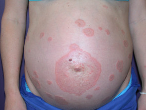 Skin problems in pregnancy