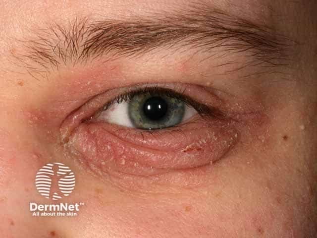 Blepharitis associated with atopic dermatitis