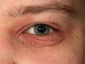 Blepharitis associated with atopic dermatitis