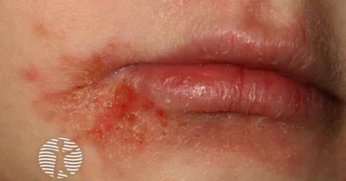 Atopic cheilitis image