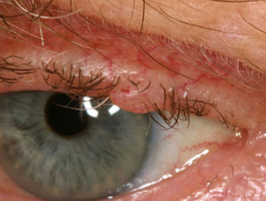 Discoid Lupus Erythematosus Early Cellulitis Eye