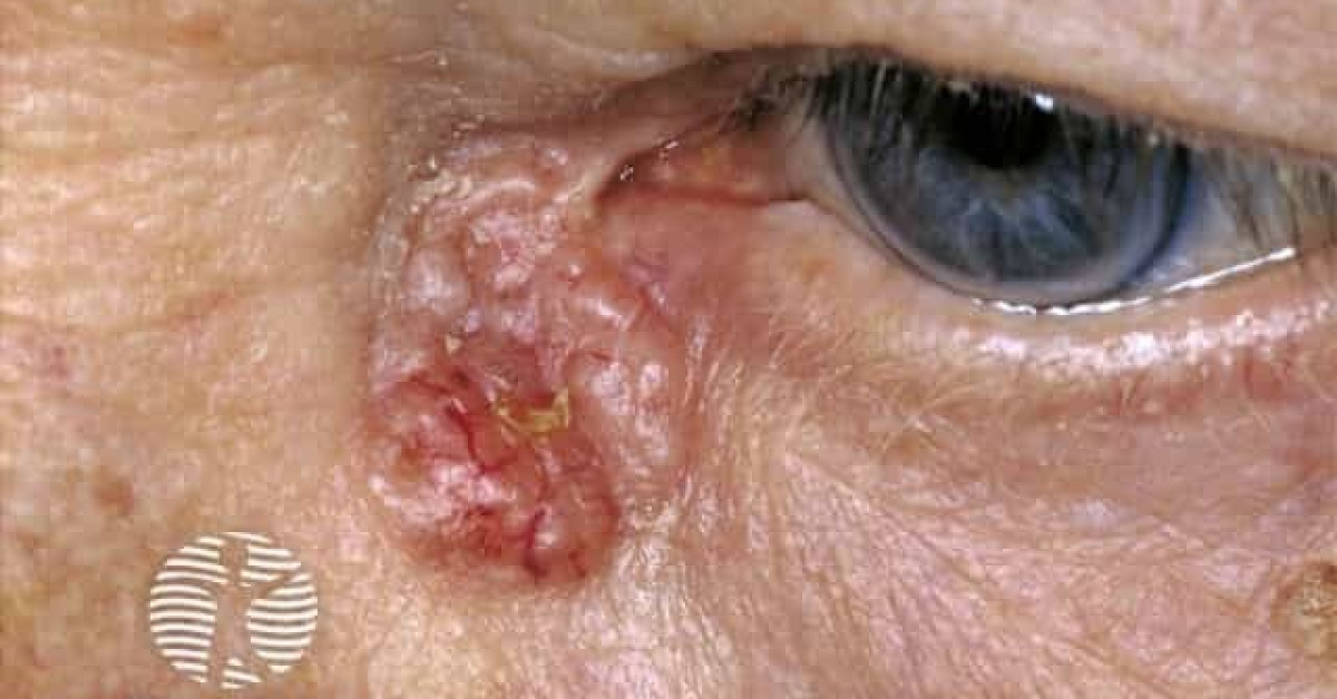 Eyelid basal cell carcinoma image
