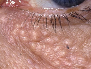 Eyelid syringomas
