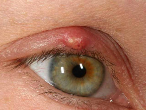 eyelid diseases