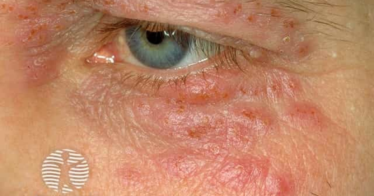 Eyelid herpes simplex image