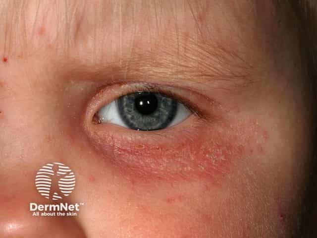 Eyelid atopic eczema
