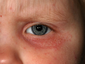 Eyelid atopic eczema