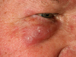Eyelid discoid lupus
