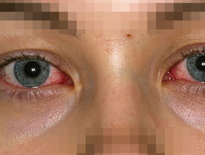 Eye involvement in Stevens Johnson syndrome