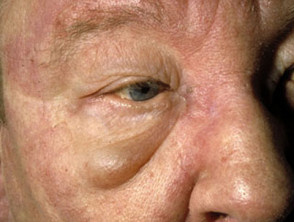 Dermatomyositis eyelid oedema