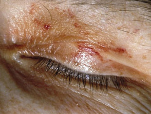 Amyloidosis of eyelid