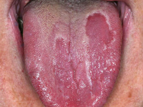 geographic tongue baby