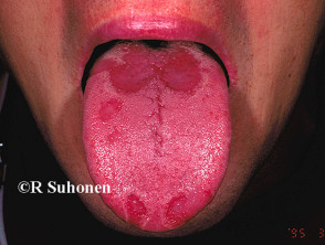 Geographic tongue