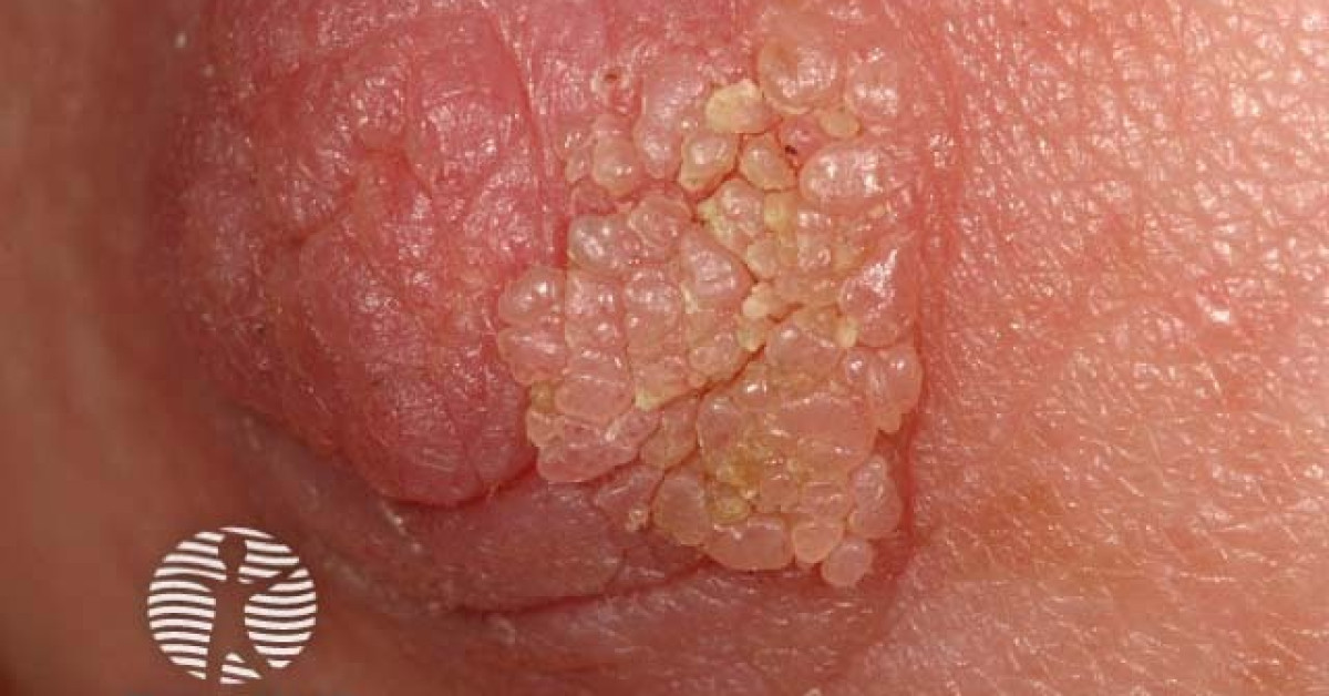 Nipple papilloma image