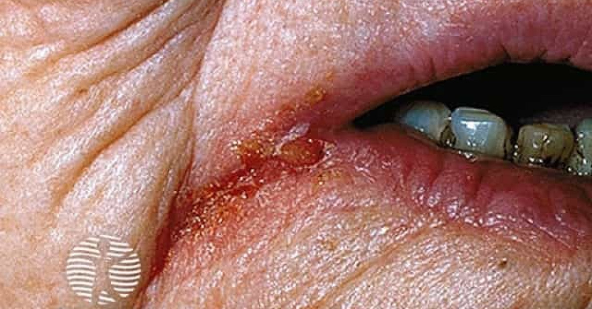 Angular cheilitis image