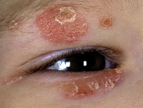 Blepharitis associated with psoriasis