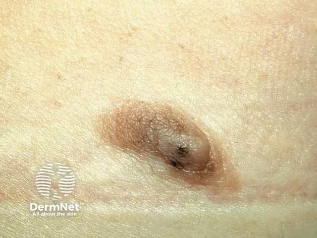 supernumerary nipple