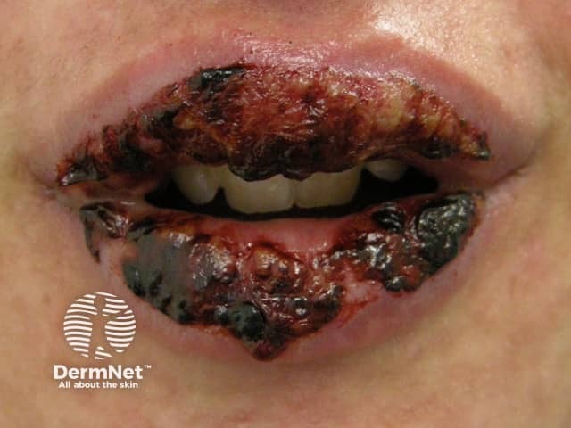 Stomatitis due to toxic epidermal necrolysis