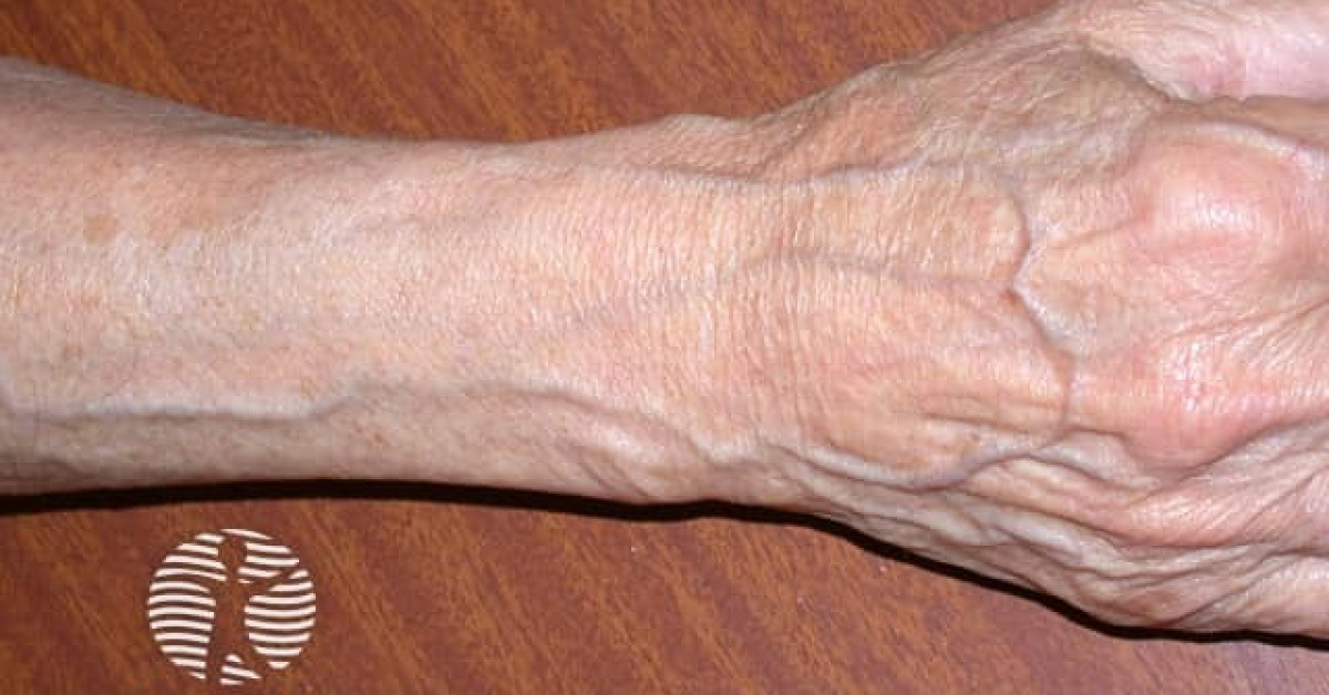 Thin skin image