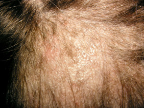 Scalp Conditions Pictures Causes and Treatments