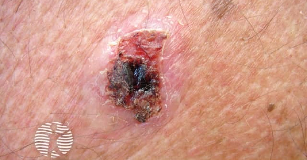 Basal Cell Carcinoma Image