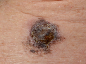 Ulcerated melanoma