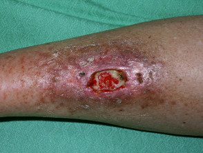 Ulcerated necrobiosis lipoidica