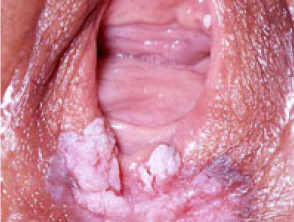 vulvar intraepithelial neoplasia (vin)