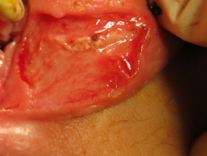 Vulval ulceration