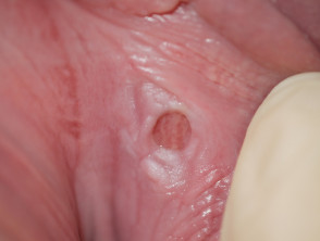 Vulval ulceration