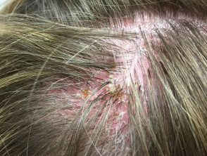 læber Menstruation Brawl Diagnosis of scalp rashes | DermNet