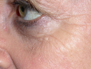 Facial lines and wrinkles