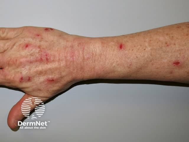 Excoriations due to compulsive skin picking