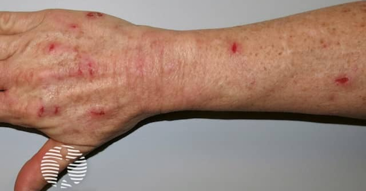 DermNet® - Excoriations due to compulsive skin picking image