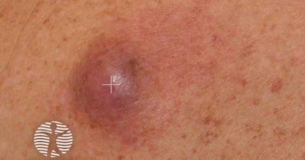 spindle-cell-melanoma-image