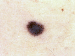 Spitz naevus (pigmented) dermoscopy