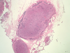 Splenosis pathology
