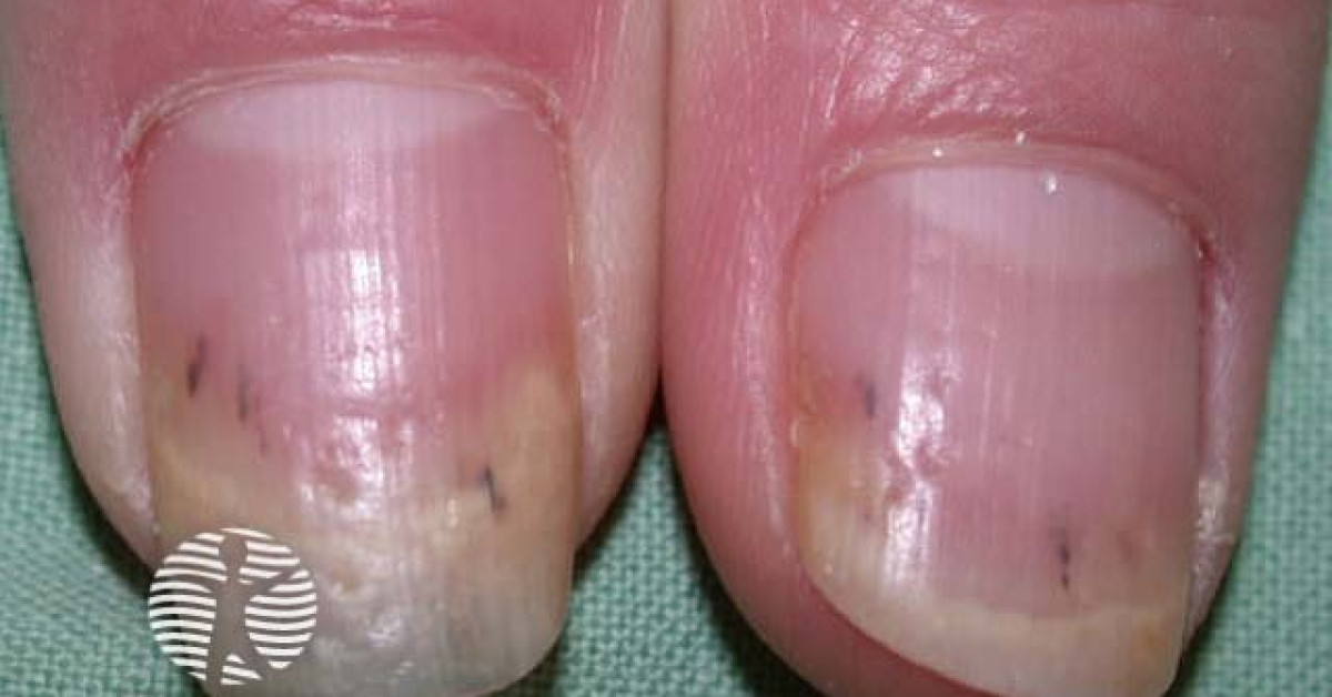 Splinter haemorrhage in psoriatic nail dystrophy image