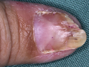 Splinter haemorrhage in psoriatic nail dystrophy