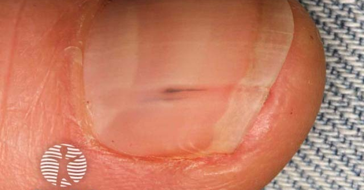 Splinter haemorrhages image