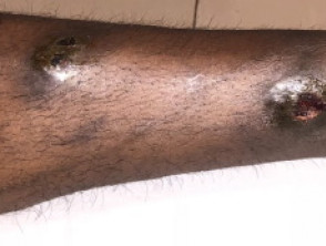 Sporotrichoid lymphocutaneous infection due to deep fungal infection