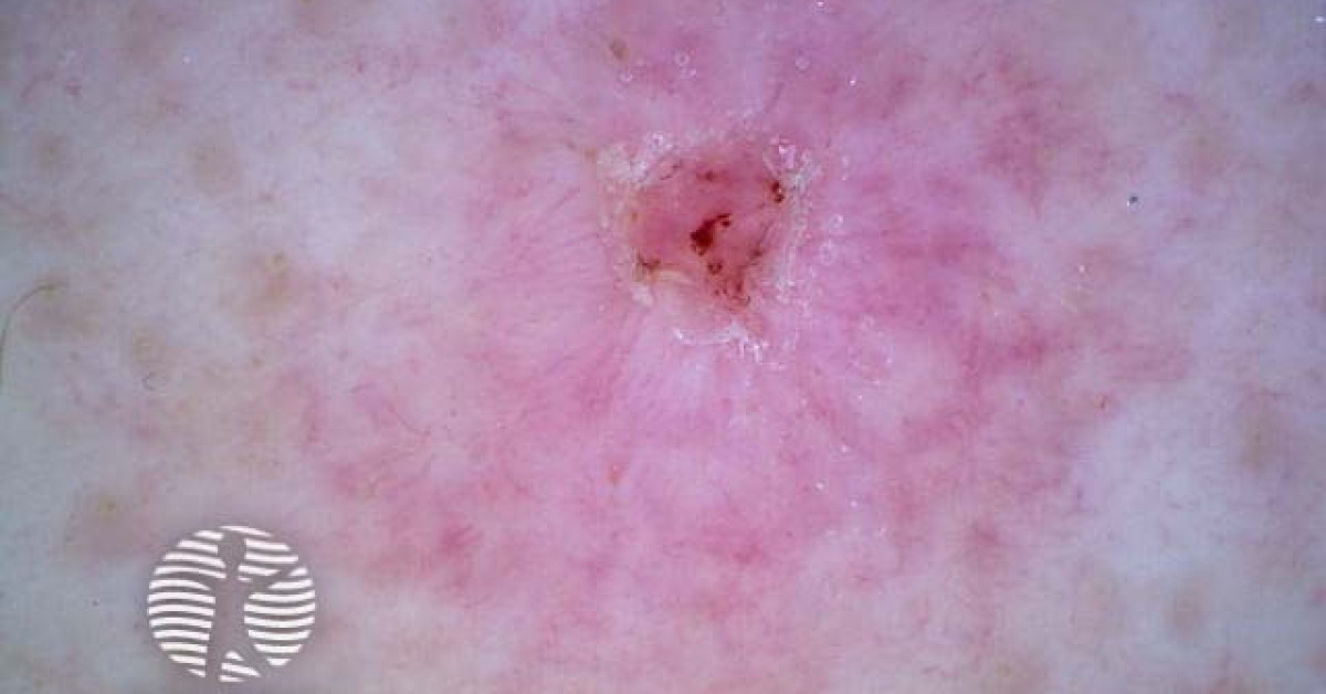 Squamous cell carcinoma nonpolarised dermoscopy view image