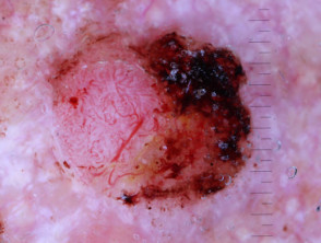 Poorly differentiated squamous cell carcinoma dermoscopy