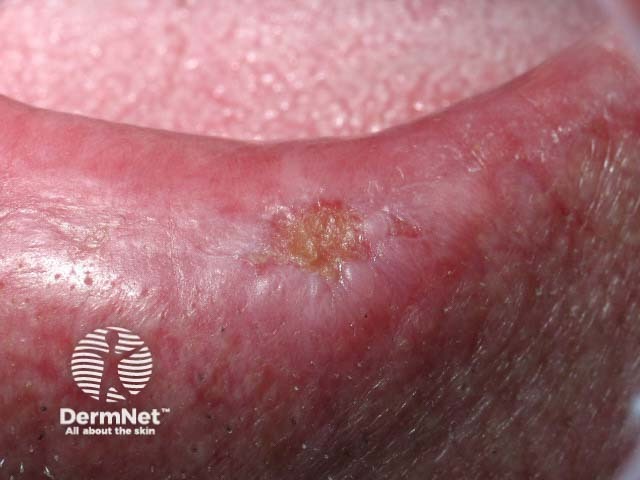 Squamous cell carcinoma of lip