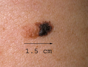 Superficial spreading melanoma